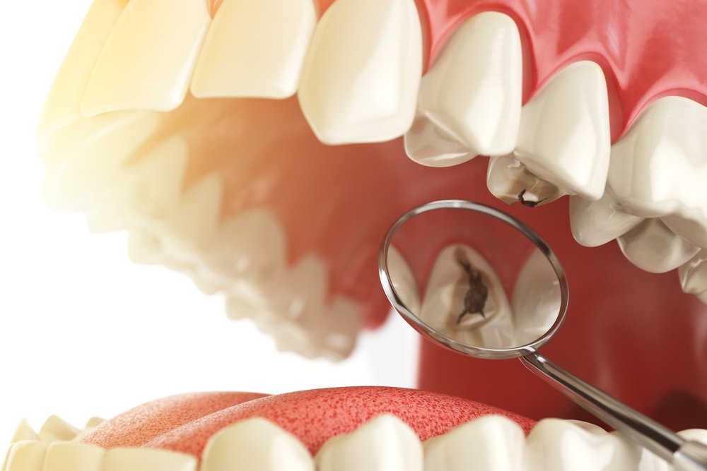 Кариес - распространённое заболевание тканей зуба, требующее оперативного лечения. Расскажем об этапах лечения, показаниях и противопоказаниях к проведению операции и рекомендациях после процедуры.