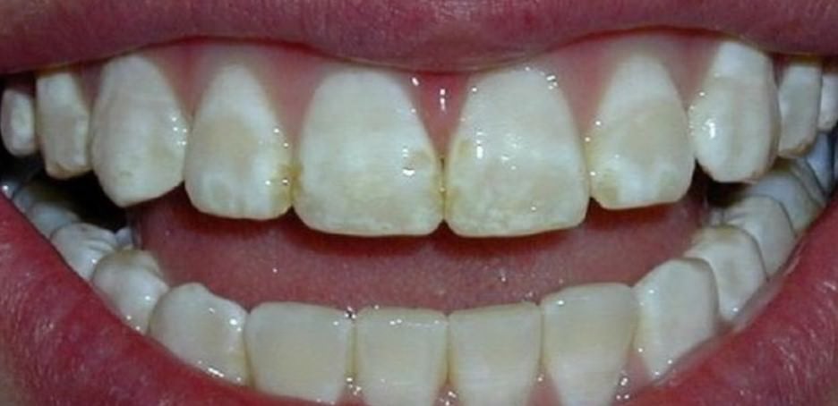 Лечение некариозных поражений зубов (клиновидный дефект, эрозия эмали, флюороз)