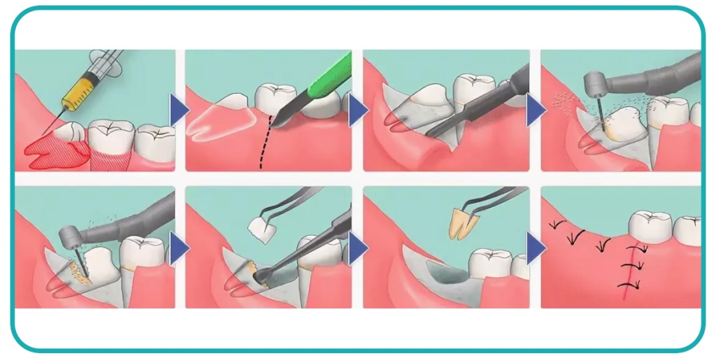 Удаление зубов при ортодонтическом лечении