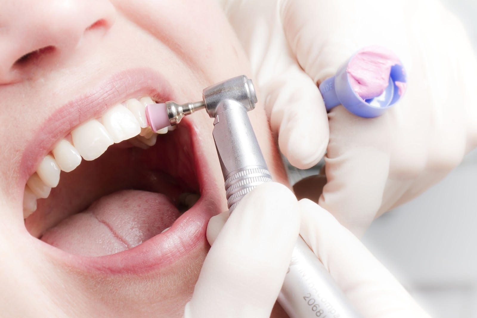 Профессиональная чистка зубов позволяет избавиться от налета и бактерий, что предотвратит возникновение воспалительных процессов, которые приводят к потери зубов. Проводить процедуру необходимо дважды в год.