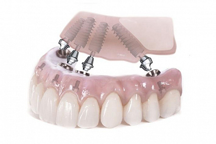 Имплантация зубов на 4 имплантатах